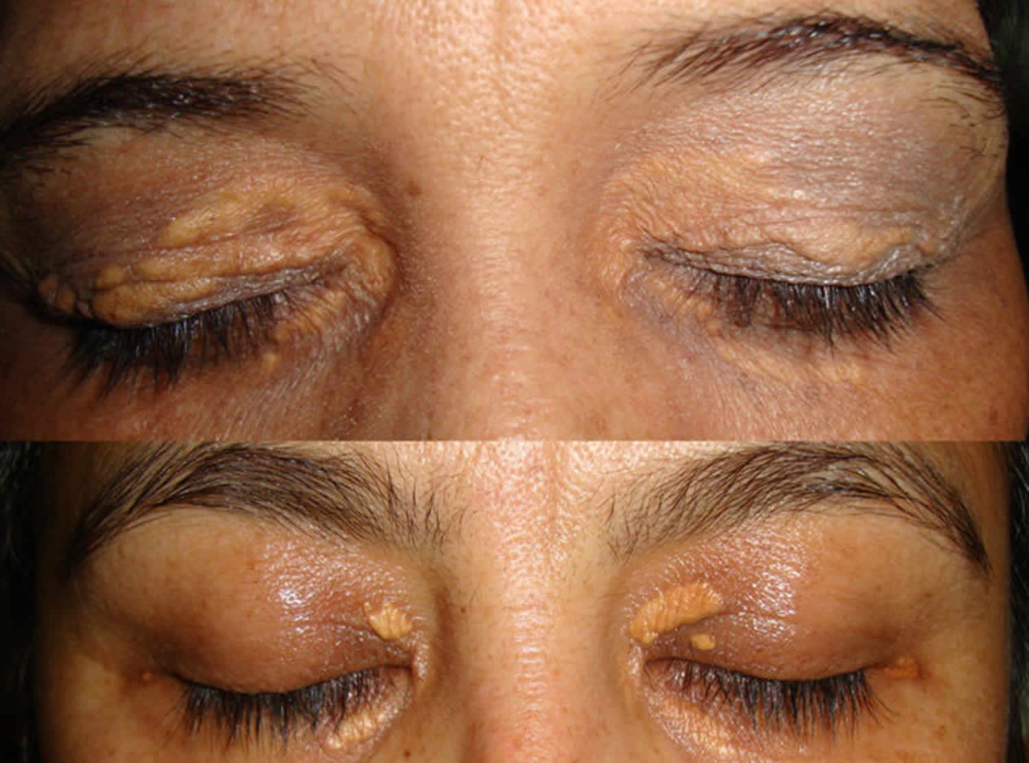 Xanthoma eye, tendinous, tuberous and disseminatum causes & treatment